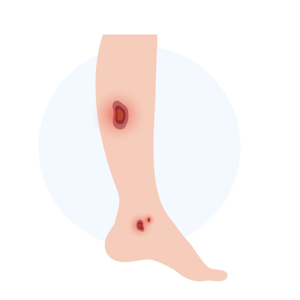Calciphylaxis Illustration